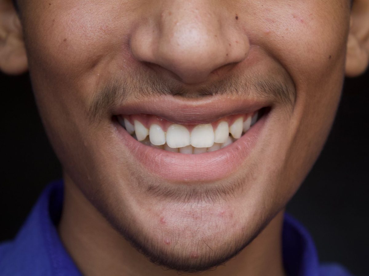 Composite fillings — smile result