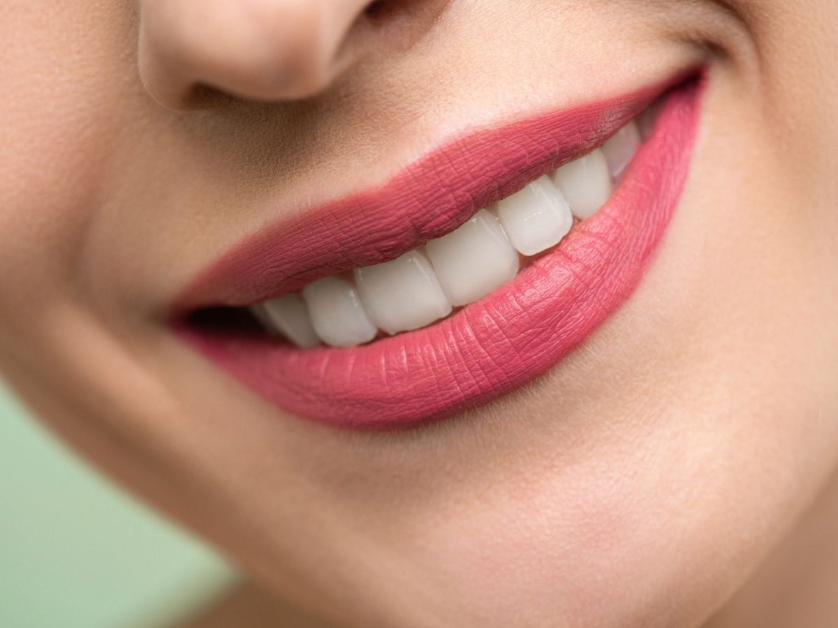 Porcelain veneers — smile result