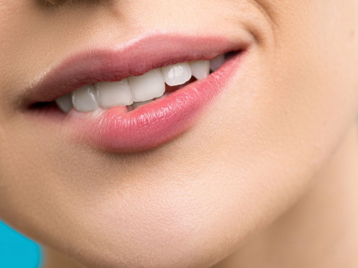 Porcelain veneers — smile result
