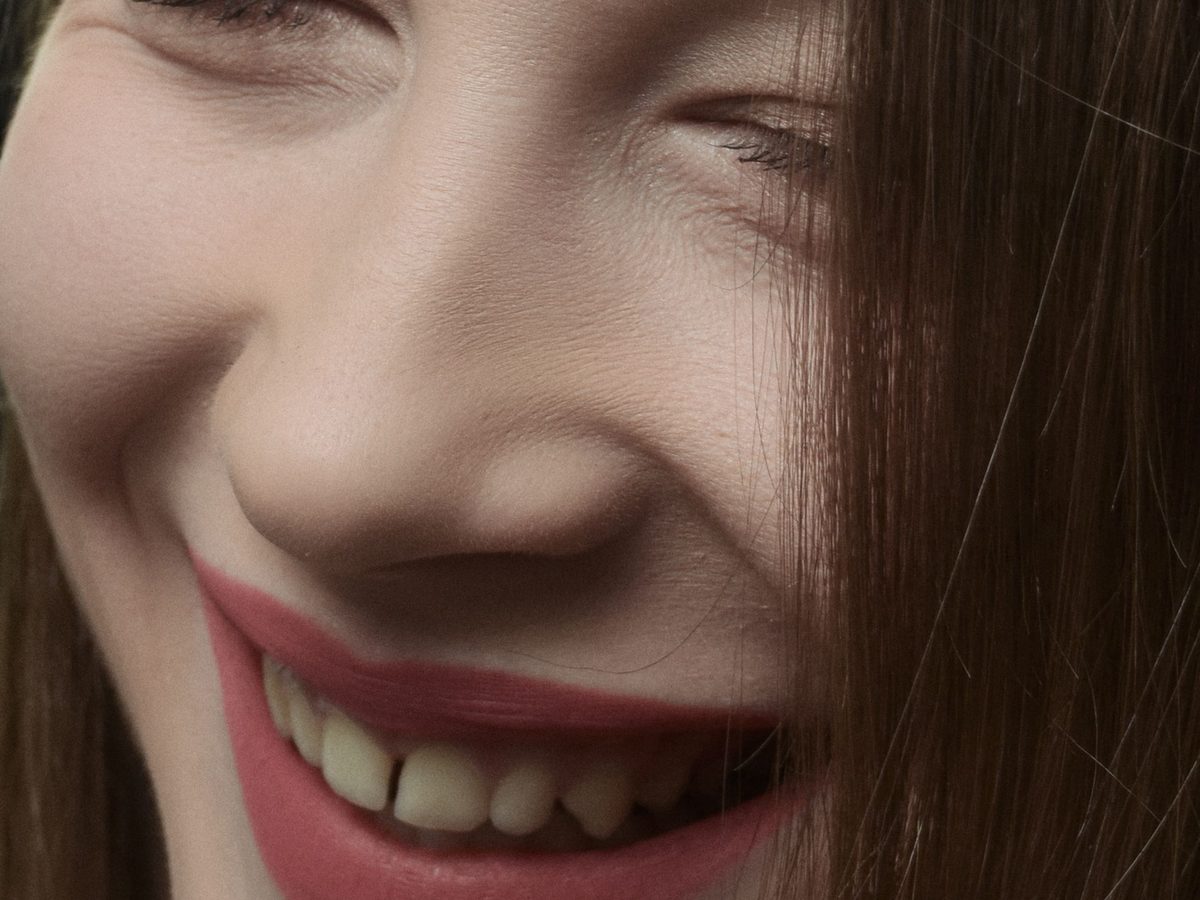 Porcelain veneers — smile result